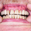 Signs-&-Symptoms-of-Gum-Diseaser