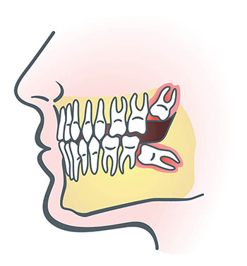 impacted-wisdom-teeth