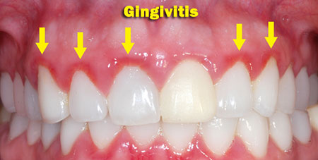 Guide To Most Common Dental Problem-Gingivitis