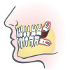 impacted-wisdom-teeth-photo2